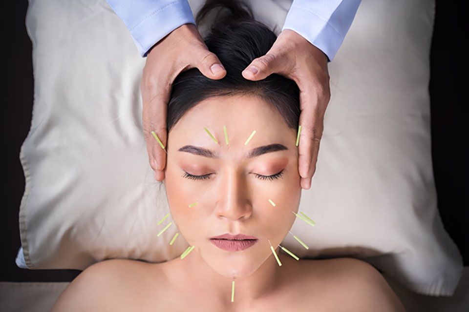 Cannabis and Acupuncture: Double Win for the EndoCannabinoid System