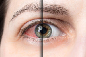 Why Does Cannabis Make Your Eyes Red
